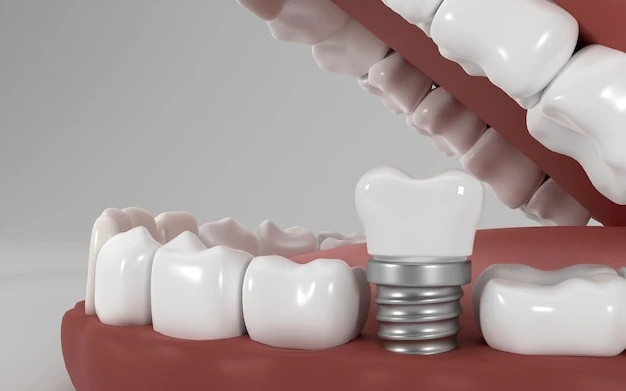 ایمپلنت دندان و کاشت دندان