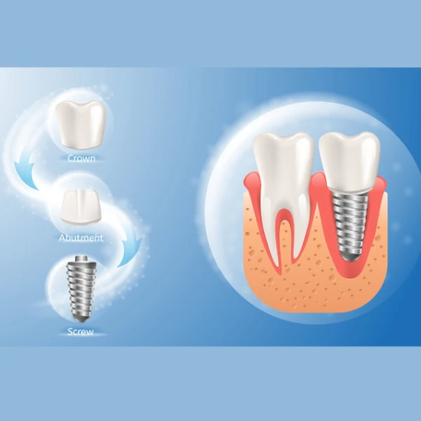 مراحل ایمپلنت دندان