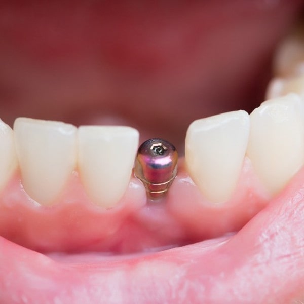ایمپلنت دندان جلو چگونه قرار می گیرد؟