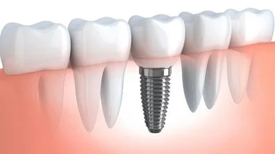 ایمپلنت دندان جلو چیست و چه مزایایی دارد؟