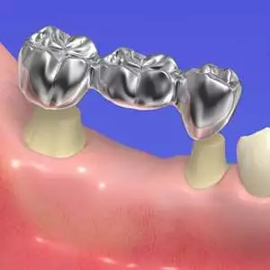 روش جایگزین ایمپلنت دندان جلو