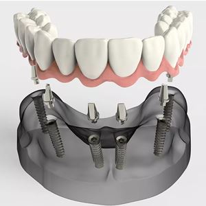 پروتز ثابت دندان چیست