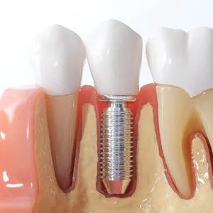 ایمپلنت ثابت دندان