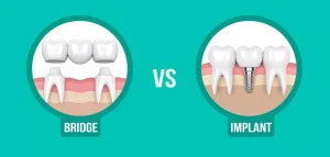 تفاوت ایمپلنت ثابت دندان و بریج