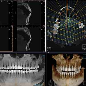 انواع ایمپلنت دندان با تصویر برداری 3 بعدی