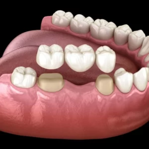 انواع کاشت دندان ثابت