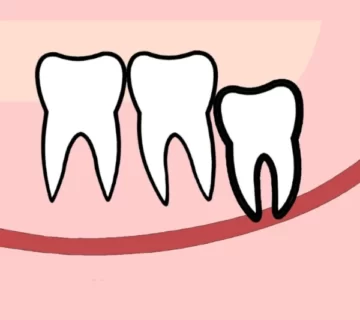 جراحی دندان عقل نهفته روی عصب