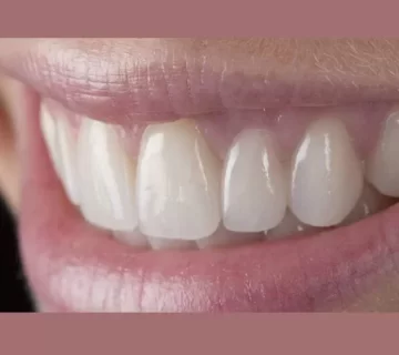 بریج دندان بدون تراش