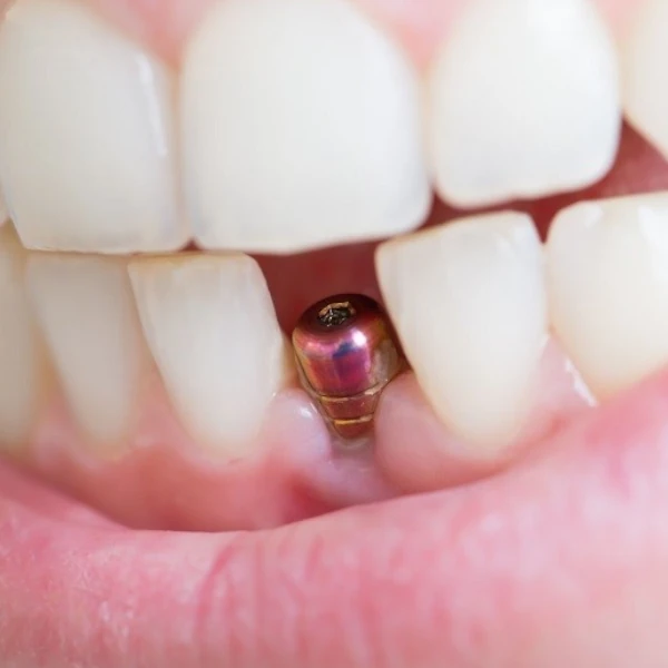 در چه شرایطی ایمپلنت دندان جلو درد دارد؟