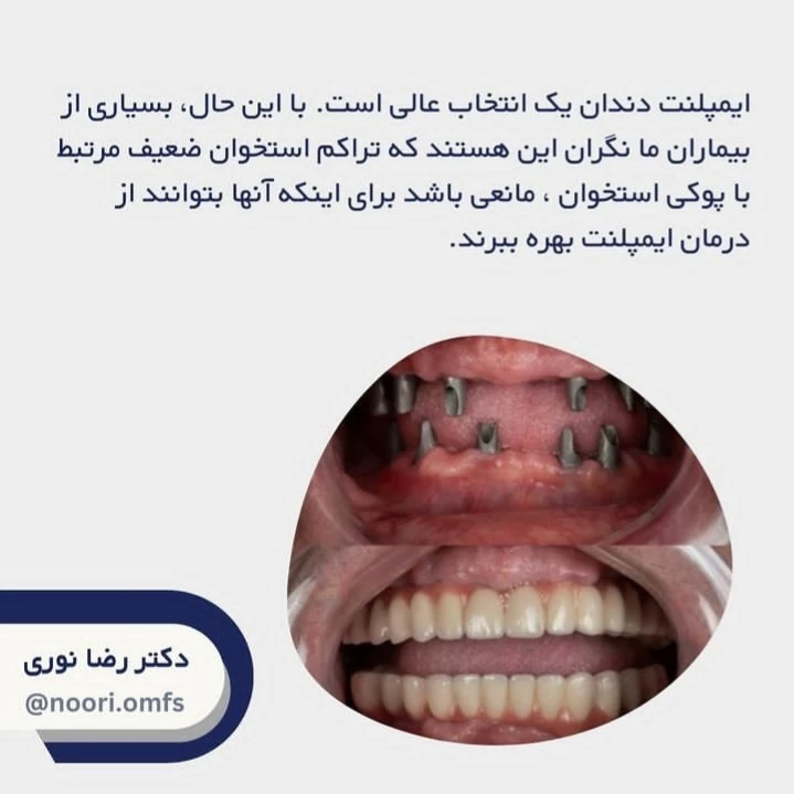 ارتباط بین ایمپلنت دندان و پوکی استخوان چیست؟