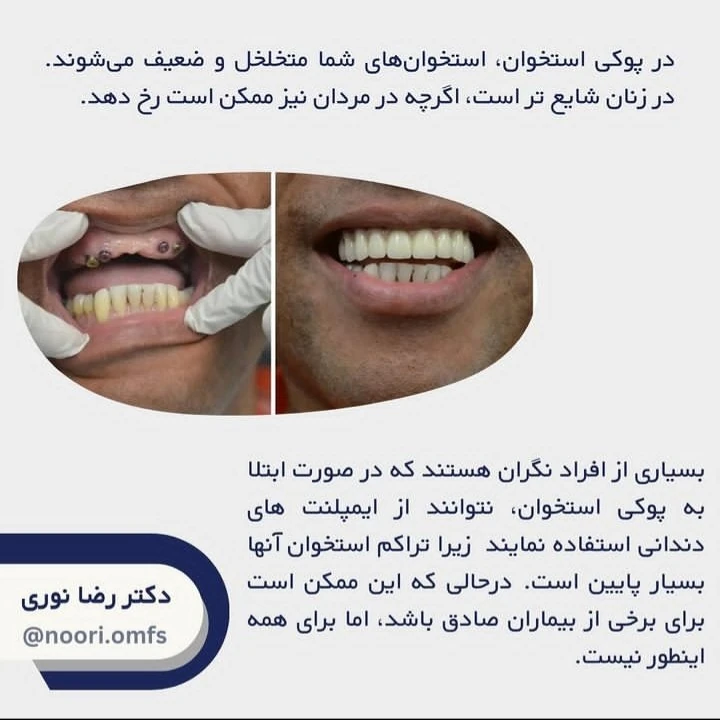 ارتباط بین ایمپلنت دندان و پوکی استخوان چیست؟