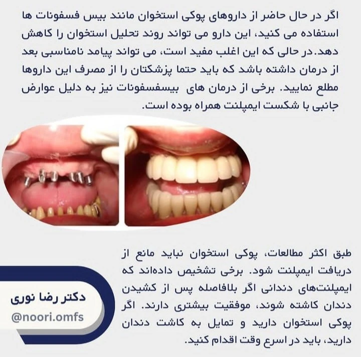 ارتباط بین ایمپلنت دندان و پوکی استخوان چیست؟