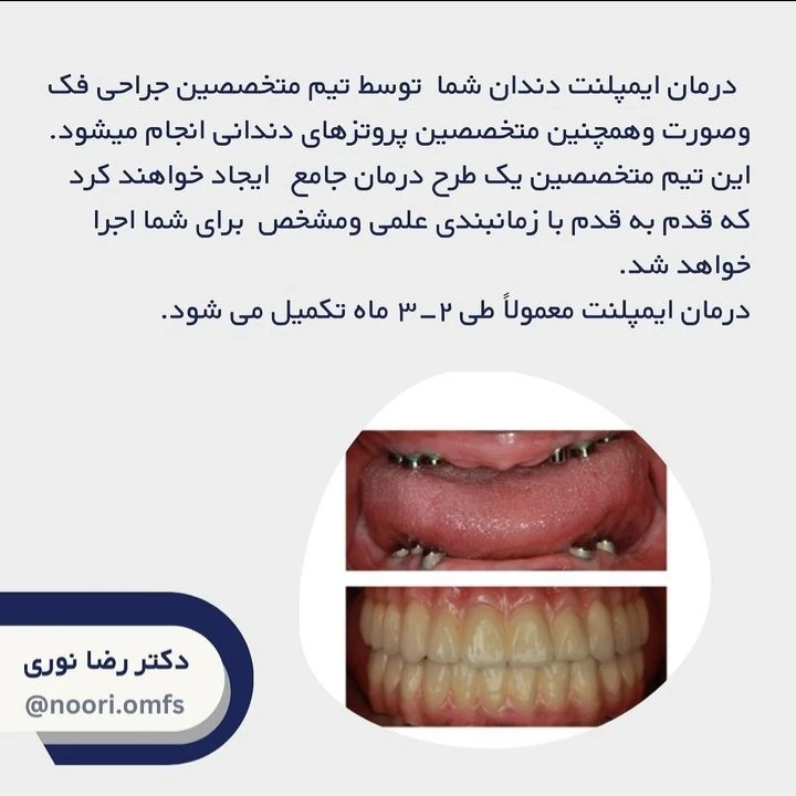 روند درمان ایمپلنت در مرکز ایمپلنت تهران