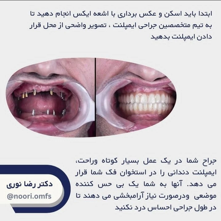 روند درمان ایمپلنت در مرکز ایمپلنت تهران