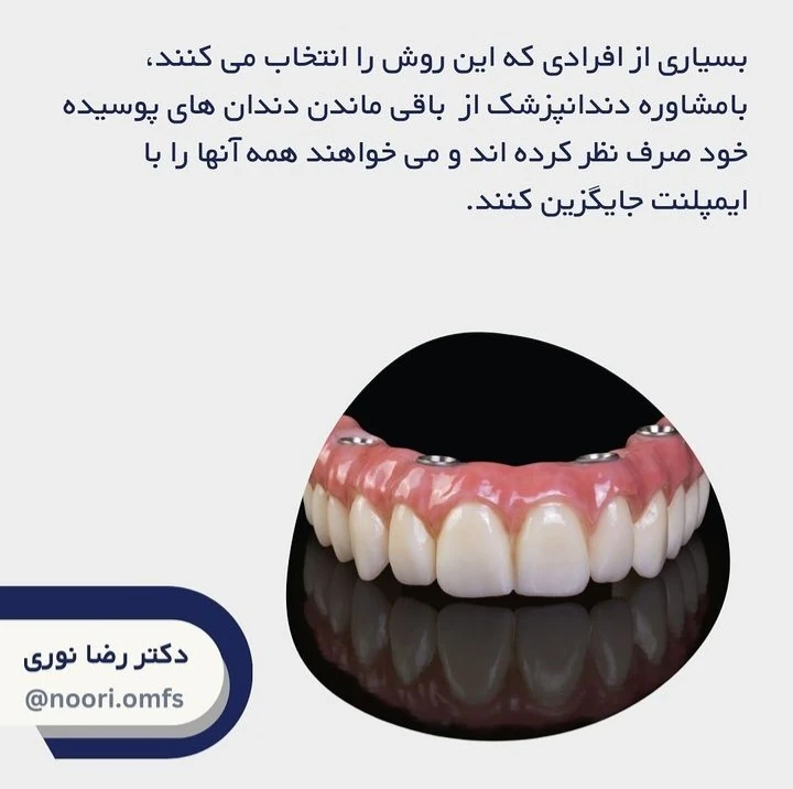 درمان ایمپلنت کامل دهان
