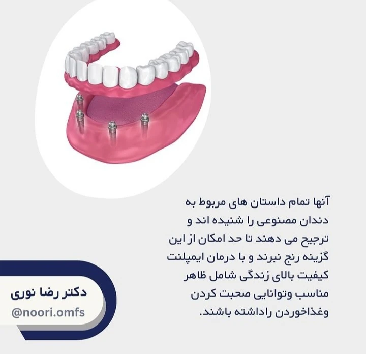 درمان ایمپلنت کامل دهان