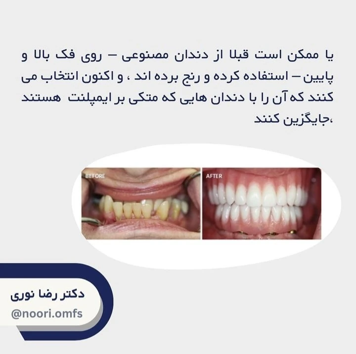 درمان ایمپلنت کامل دهان