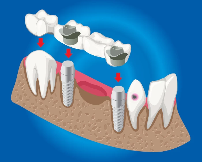 دندان مصنوعی در مقابل پل دندان