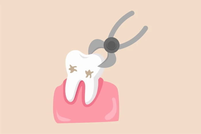 آیا کشیدن دندان عقل نهفته درد دارد؟ - فرآیند