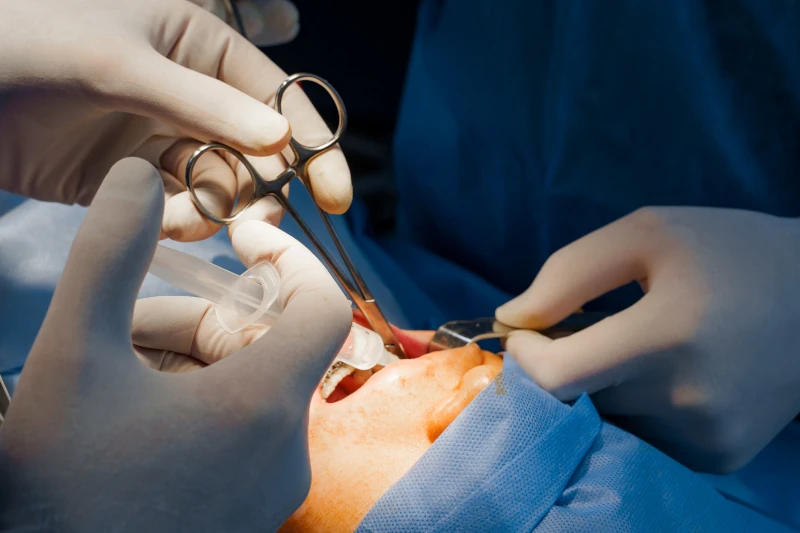 فرایند گام به گام جراحی دندان عقل نهفته با بیهوشی