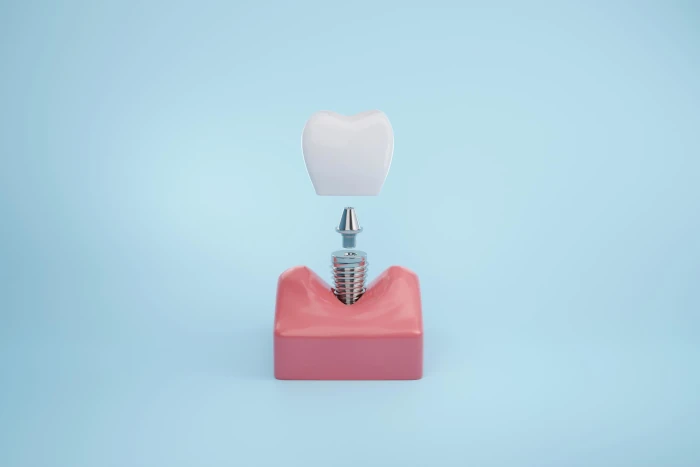 آیا کاشت دندان با ایمپلنت فرق دارد - انتخاب