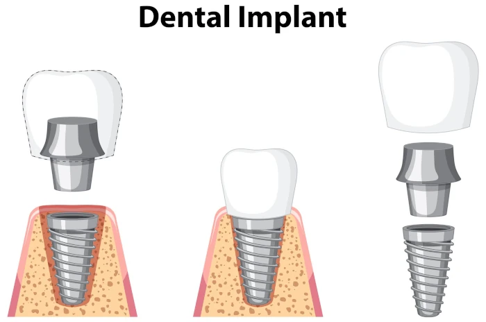فرق ایمپلنت و کاشت دندان - مراحل