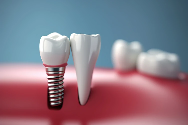 ایمپلنت دندان برای چه کسانی مناسب نیست - معایب