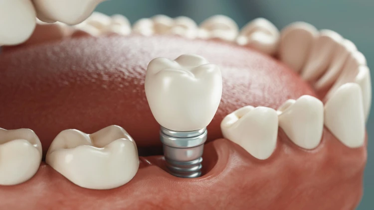 مقایسه ایمپلنت و دندان مصنوعی - دوام