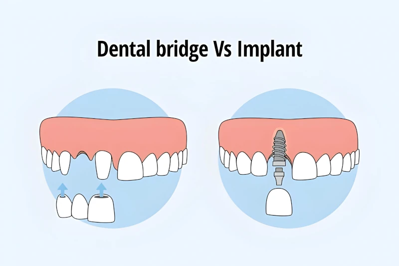مقایسه ایمپلنت و بریج دندان
