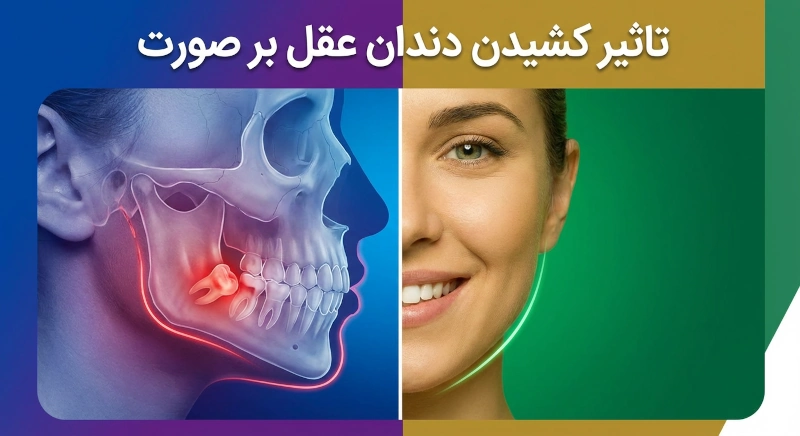 تاثیر کشیدن دندان عقل بر صورت